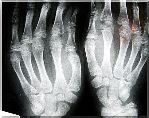 X-ray image showing degeneration of the fingers