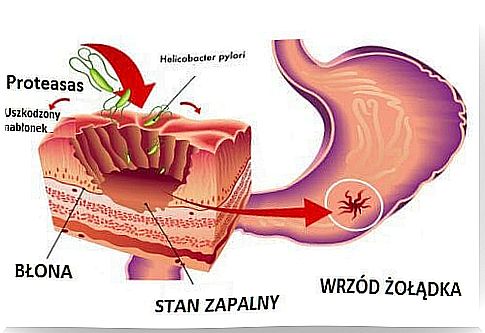 Helicobacter pylori bacteria - how to fight it?