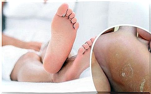 Lumps on the feet - treat them with home remedies