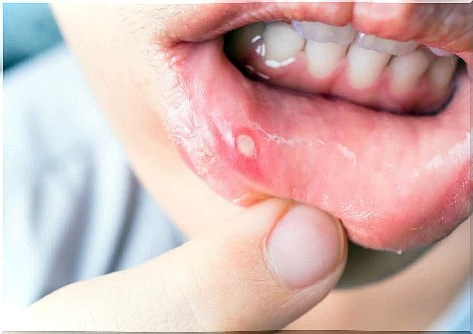 Mouth ulcers - 7 treatments