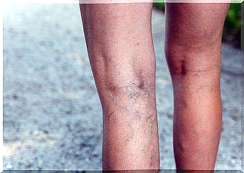 Varicose veins on the legs