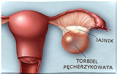 Ovarian cyst - prevention and detection