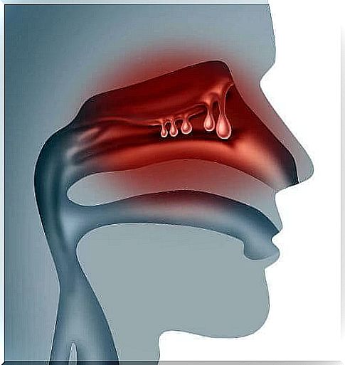 Polyps in the nose: symptoms, causes and treatment