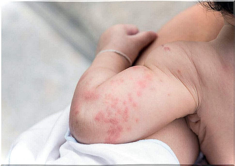 Heat rash in infants - are they a cause for concern?