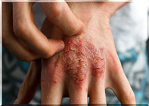 Psoriasis on the hands