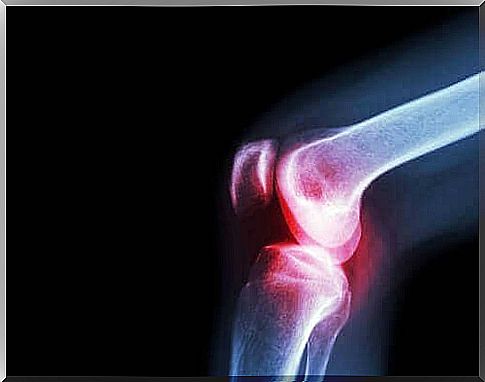 Septic Arthritis: Causes, Symptoms, and Treatment