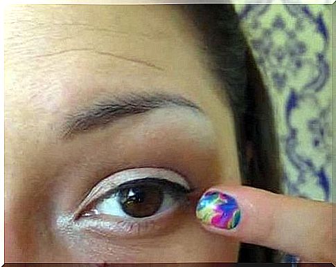 A woman's eye and swollen eyelids