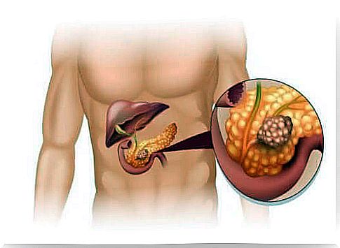 Treatment of pancreatic neuroendocrine tumors