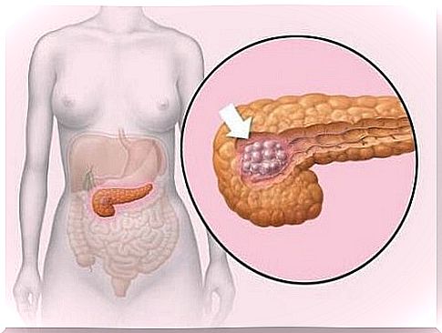 Pancreatic tumors