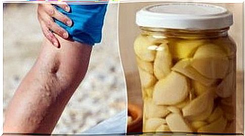 Varicose veins?  Cure them home remedy with orange