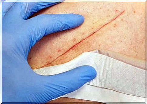 Wound Healing - Learn the basic techniques for this